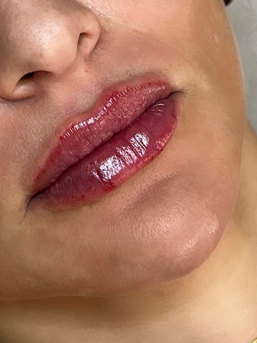 Luana depois do preenchimento labial